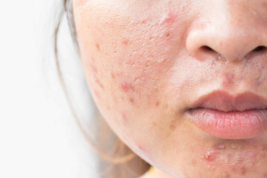 Fade-pimple-scars